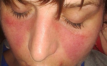 arthritis treatment in Delhi