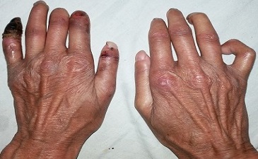 arthritis treatment in Delhi